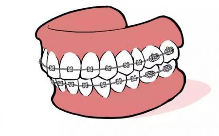 牙套是怎么固定在牙齿上的(矫正牙齿固定牙套大概多少钱)