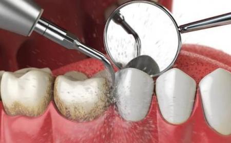 如何祛除牙垢和牙结石(去牙垢牙结石最有效的牙膏)