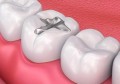 嵌体补牙较传统补牙的优点(嵌体补牙跟玻璃补牙的区别)