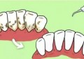 去除牙结石可以用溶解牙石疗法(用最好的方法去除牙结石)