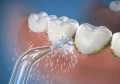 生活中怎么预防牙齿长牙结石(生活中怎么预防牙齿长牙结石的)