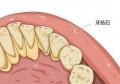 牙结石的预防(牙结石的预防与处理)