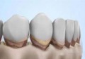 牙结石怎么形成的原因(容易长牙结石的原因)