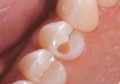 嵌体补牙和树脂补牙的区别(牙齿嵌体和树脂)