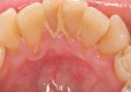 牙结石对口腔的坏处(牙结石会导致口腔溃疡吗)