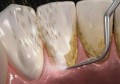 牙结石是怎么形成的